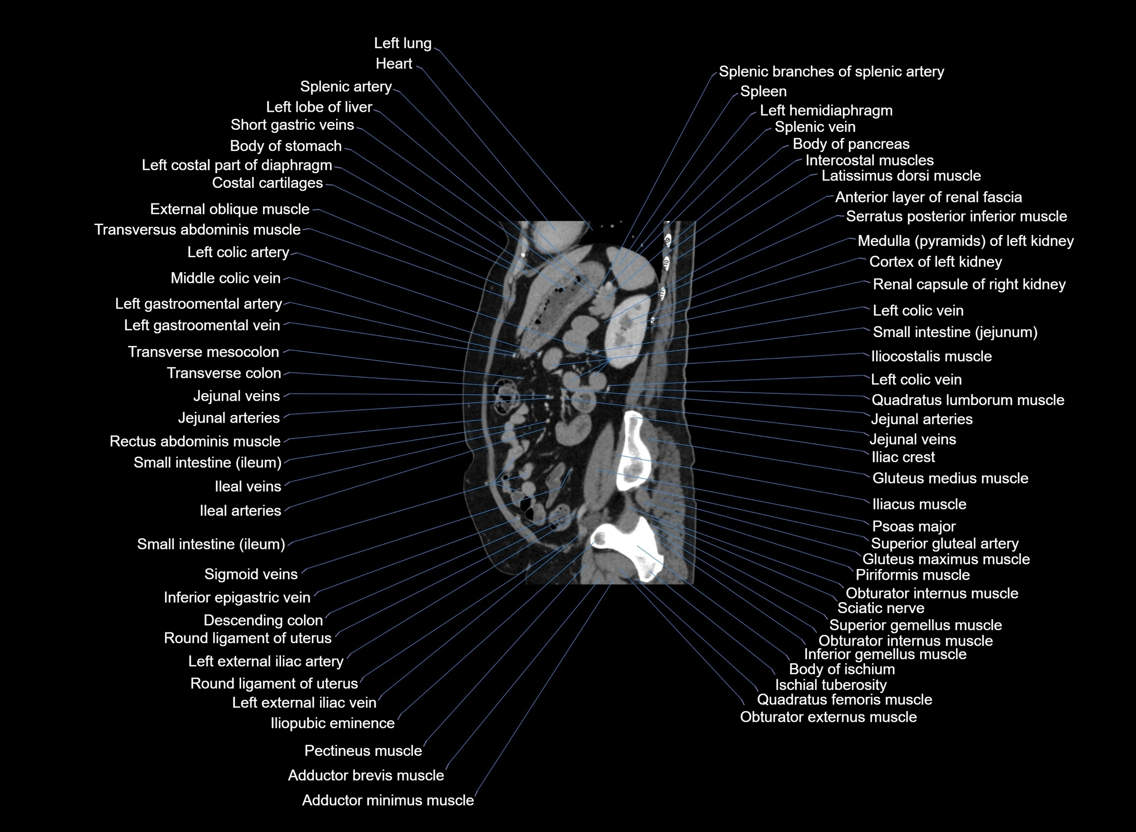 CT Abdomen sagittal cross sectional anatomy labelled radiology image -00037.webp